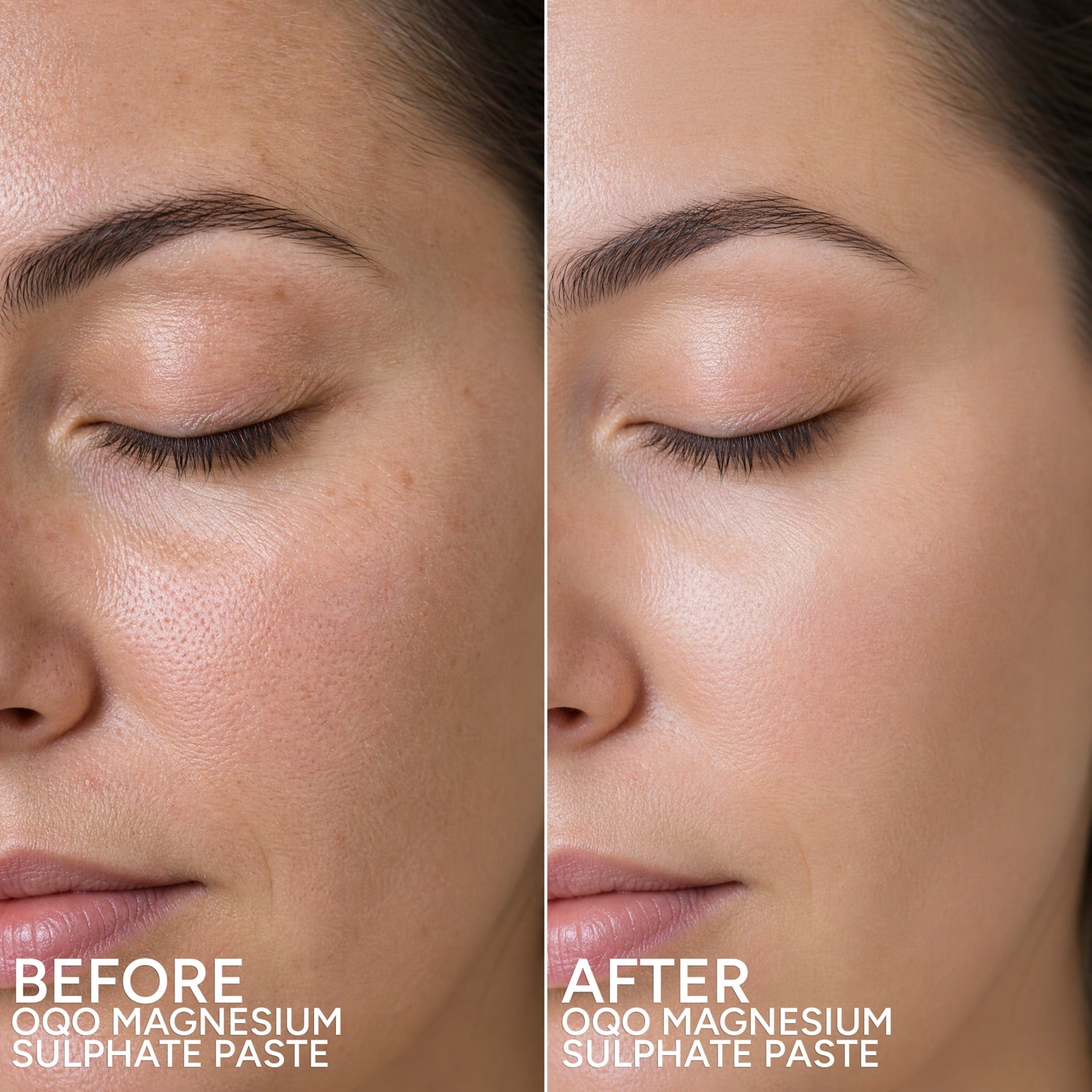 Facial skin before and after use of OQO Magnesium Sulphate Paste