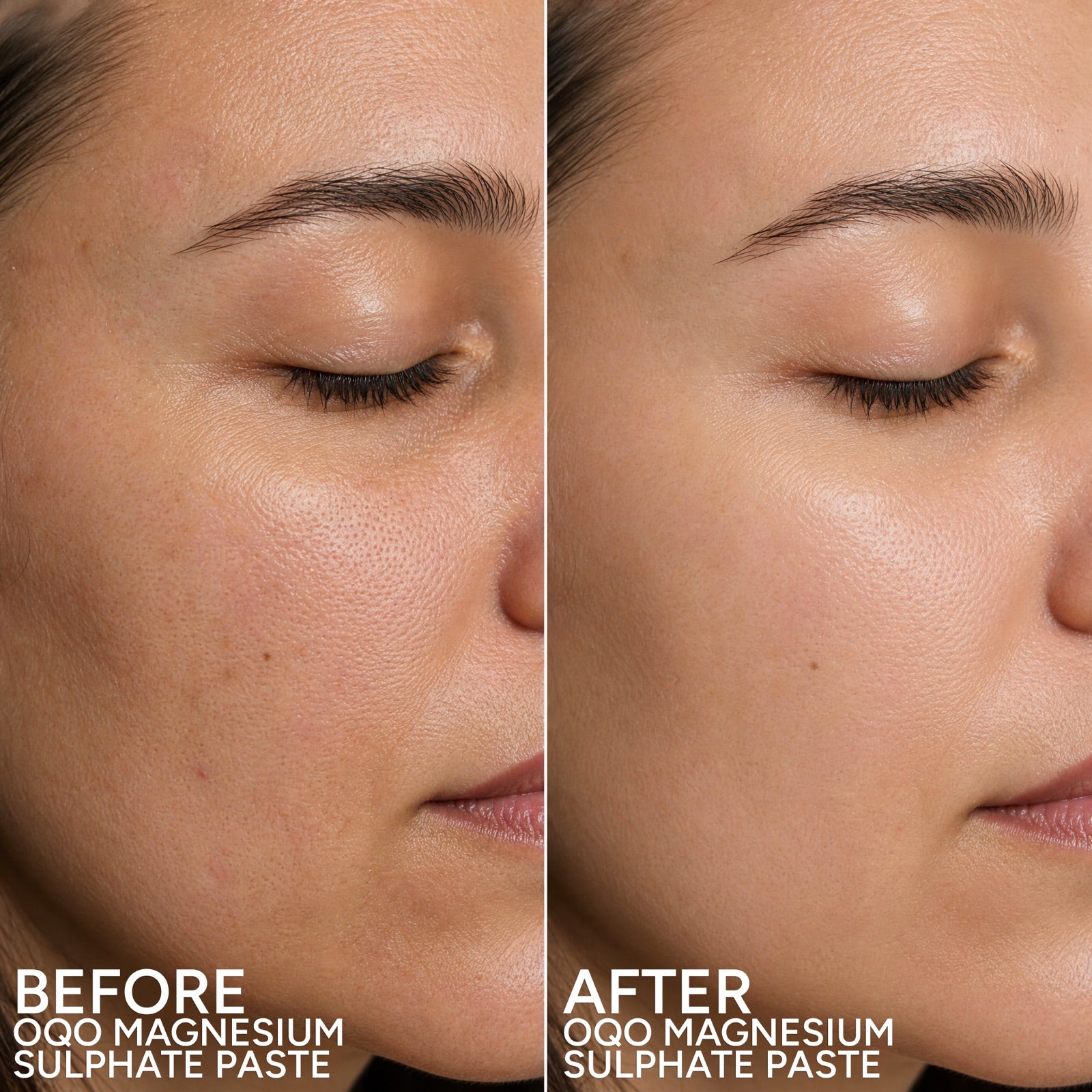 Facial skin before and after use of OQO Magnesium Sulphate Paste