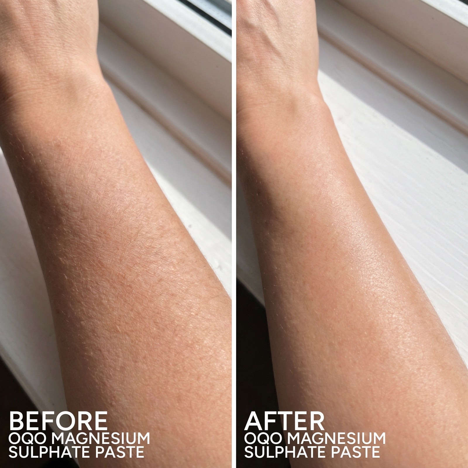 Arm before and after use of OQO Magnesium Sulphate Paste