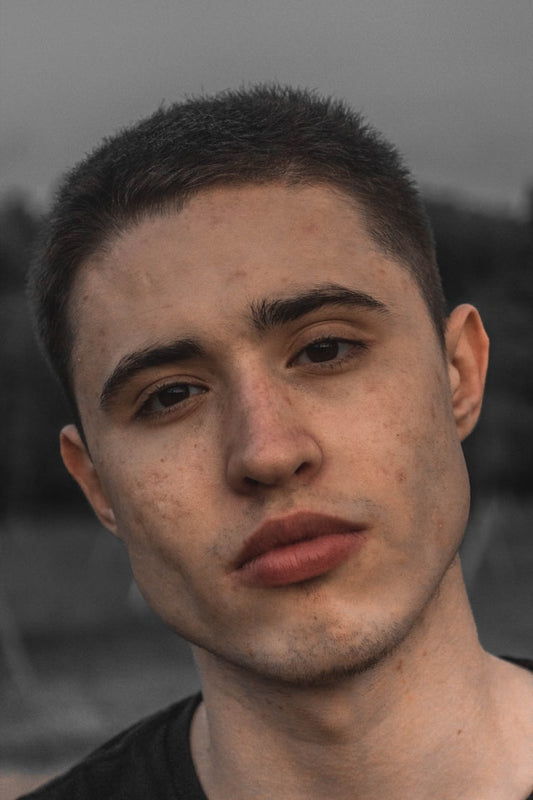 Man with mild acne staring into the camera with a neutral expression