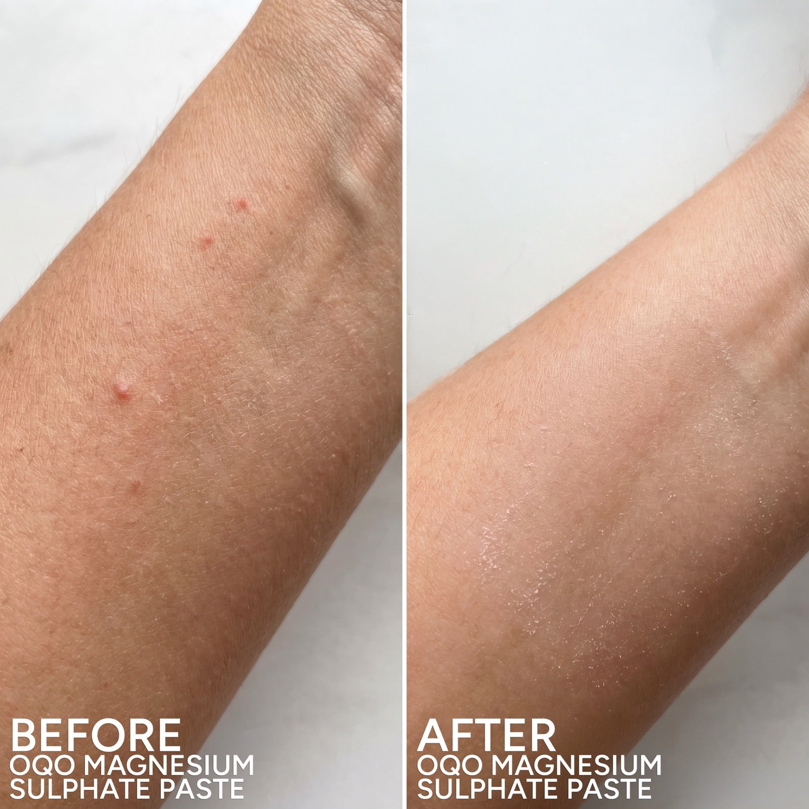Hand before and after use of OQO Magnesium Sulphate Paste